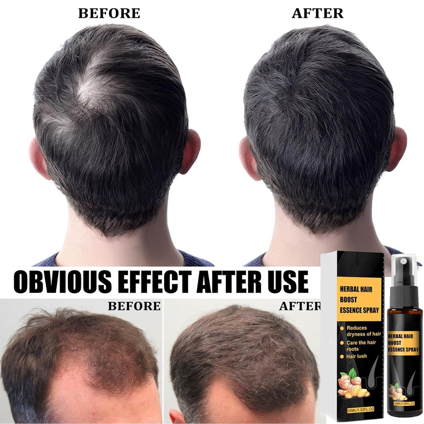 Advanced Hair Growth Treatment Kit 30 ml 2PCS Haarwachstumsspray Haarwachstumsroller und Essenz-Set Haarwachstumsserum Anti-Haarausfall Advanced Hair Growth Serum Haarpflege Naty Shop